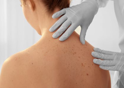 Dermatologist examining patient in clinic, closeup