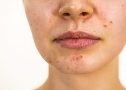 Young woman showing her face with acne and moles, dry lips. Teen girl no make up with red spots on her chin. Health problem, skin diseases.